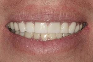 Smile after teeth whitening procedure