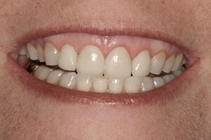 Patient after teeth whitening