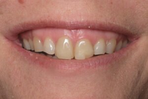 Patient before teeth whitening