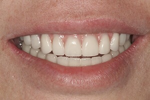 Smile after dental bridges