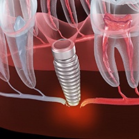 A 3D illustration of a failed dental implant