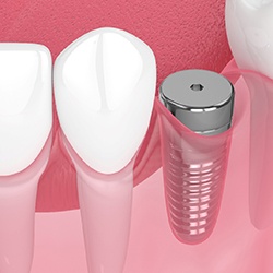Dental implant in Midwest City, OK with protective cap