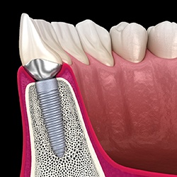 Single dental implant in Midwest City, OK supporting a crown