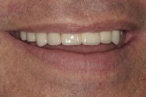 After tooth replacement smile