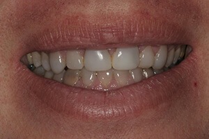 Smile before teeth whitening procedure