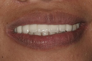 Smile after dental implants