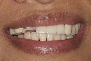 Smile before dental implants