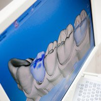Close up digital image of teeth before CEREC one visit dental crown restoration