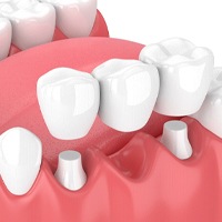 traditional dental bridge in Midwest City