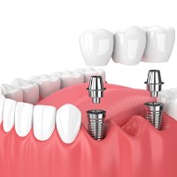 implant dental bridge in Midwest City