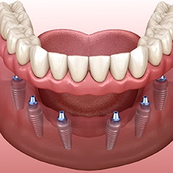 Dentures for lower arch supported by six implants