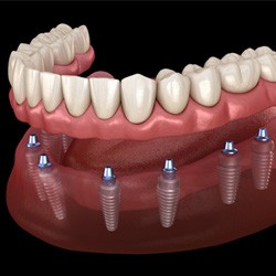 a digital illustration depicting how implant dentures work