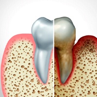 Illustration of how gum disease affects gum tissue