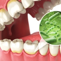Illustration of bacteria attacking gum tissue, causing gum disease