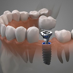 Diagram of dental implants in Midwest City