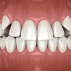 crowded teeth that can benefit from Invisalign in Midwest City