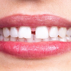 gapped teeth that can benefit from Invisalign in Midwest City