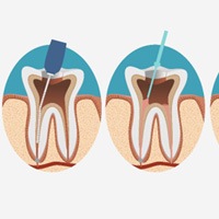 illustration for root canal therapy in Midwest City  