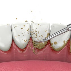 Illustration of scaling and root planing for gum disease in Midwest City, OK