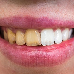 Comparison results of teeth whitening treatment