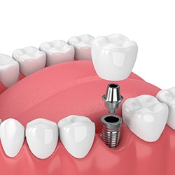 Diagram of a single tooth dental implant in Midwest City