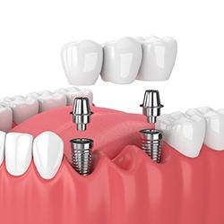 Diagram of implant bridge replacing multiple missing teeth in Midwest City