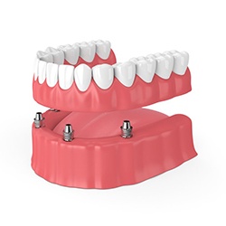 Diagram showing an implant denture in Midwest City