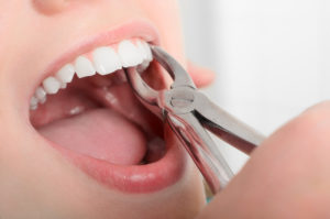 woman mouth open having tooth extracted