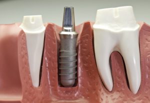 Model for titanium dental implants