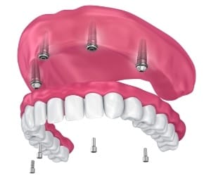 Model showing the basics of dental implants