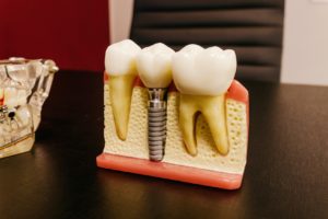 Model of a single dental implant